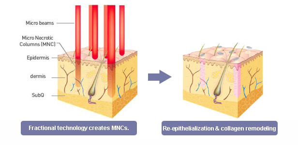 LASER RESURFACING